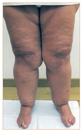 lipedema pelo plano de saúde